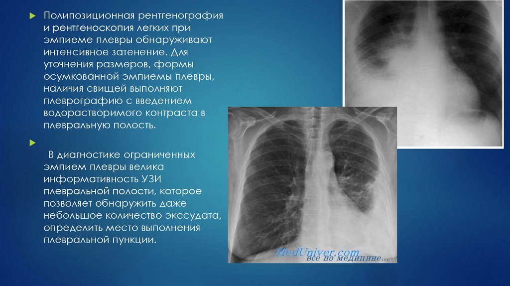 Описание рентгеновского снимка. Эмпиема легких рентген. Осумкованная эмпиема рентген. Тотальная эмпиема плевры рентген. Плеврит легких рентген.