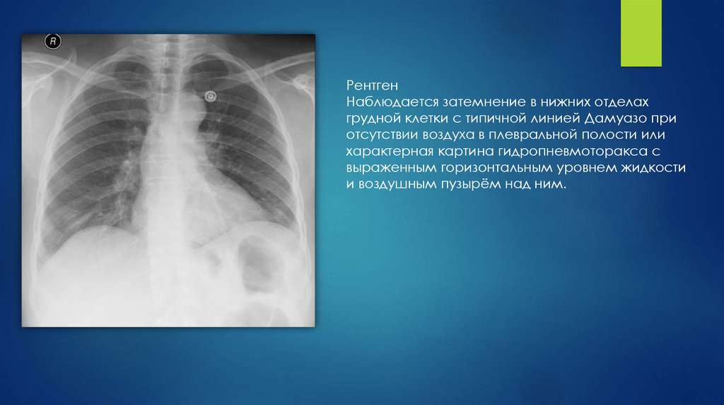 Сухой плеврит рентгенологическая картина