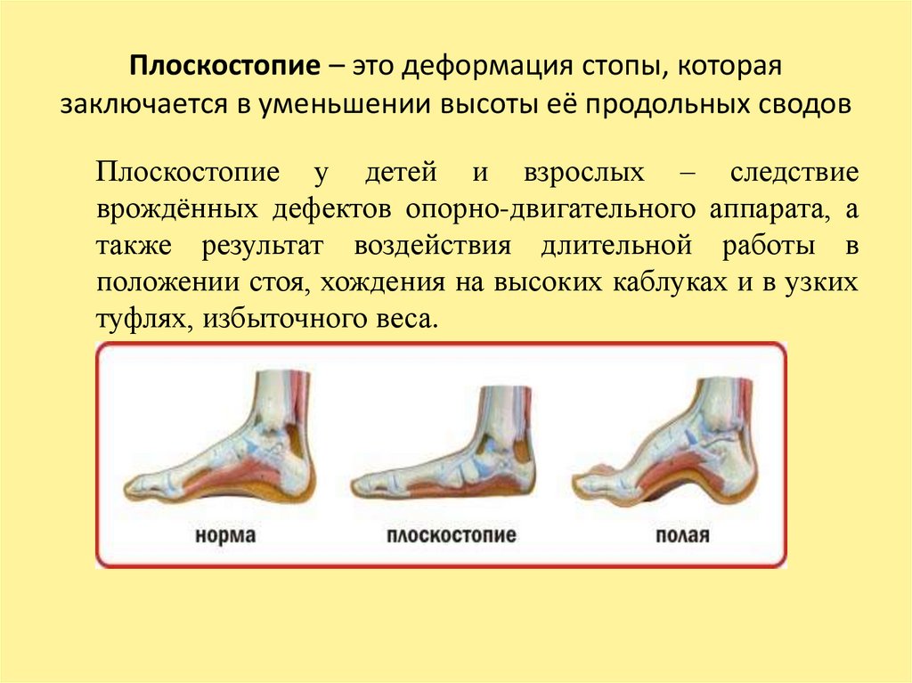 Плоскостопие это. Нормальное формирование свода стопы. Типы плоскостопия у взрослых.