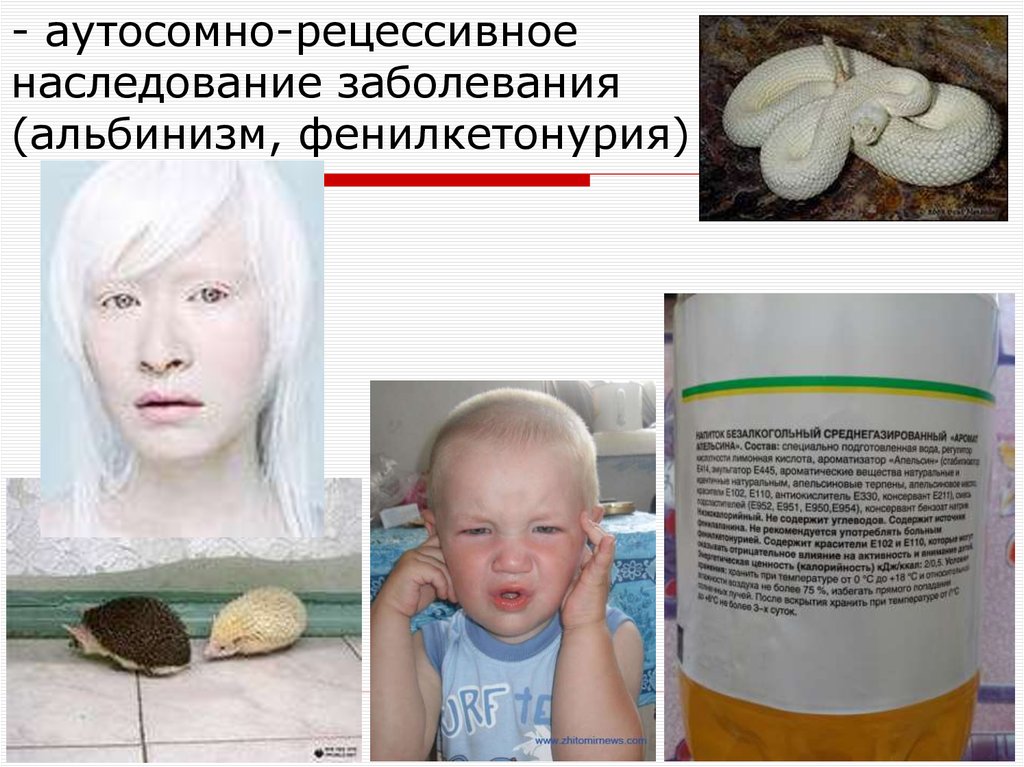 Альбинизмом страдают. Альбинизм аутосомно рецессивный. Наследственная болезнь альбинизм.
