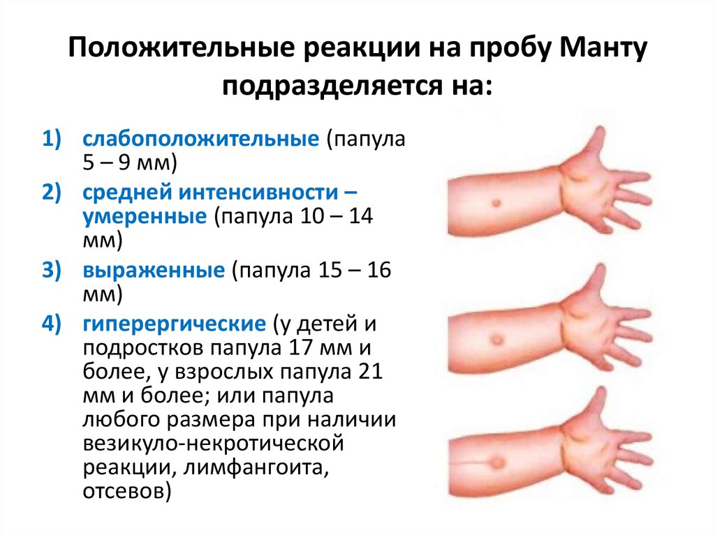 Через сколько делать прививку после манту. Реакция манту норма у детей 12 лет. Туберкулиновая проба манту норма. Туберкулиновая проба диаскинтест нормы. Туберкулиновая проба реакция манту у детей.