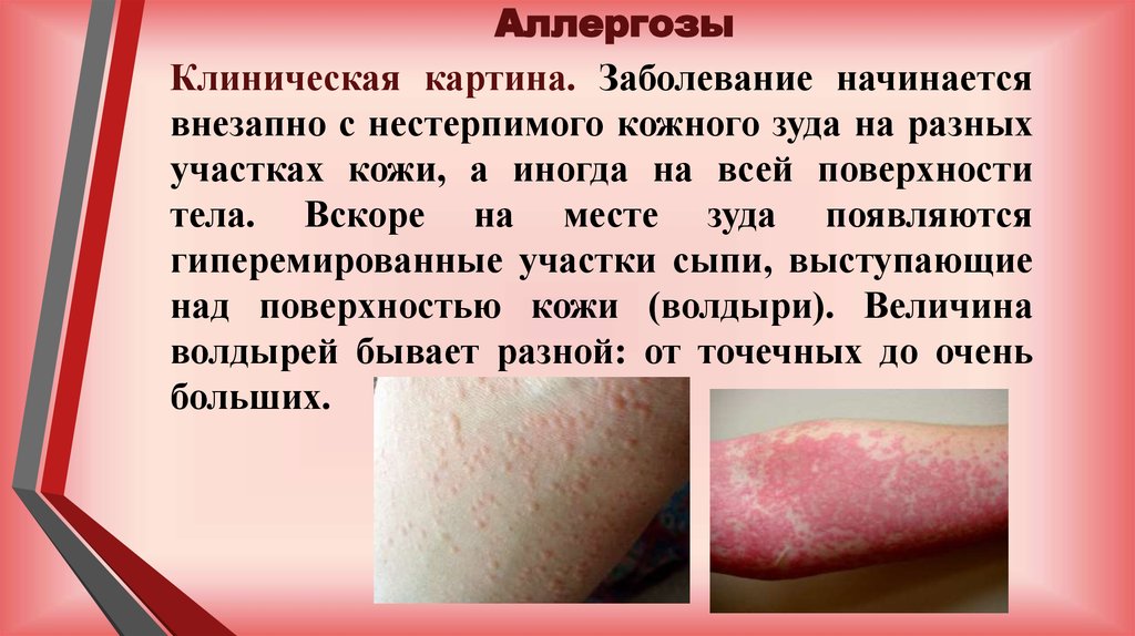 Аллергозы