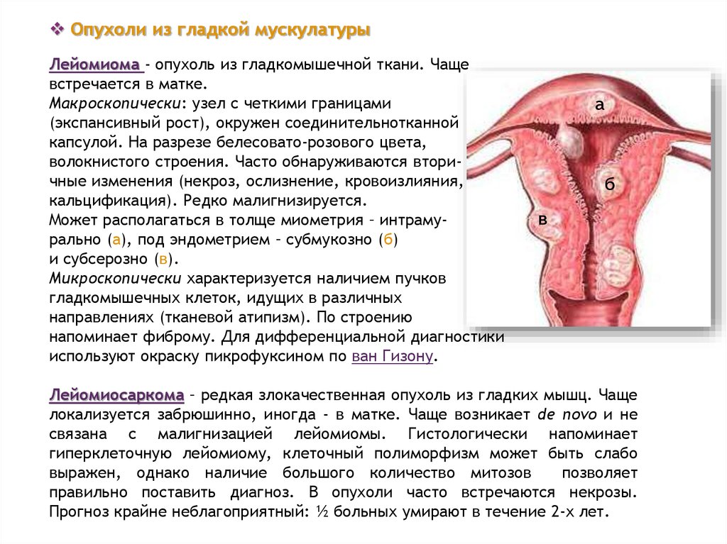 Подслизистая лейомиома матки что это. Опухоль - лейомиома рост. Опухолевый узел в лейомиоме. Опухоль гладкой мышечной.