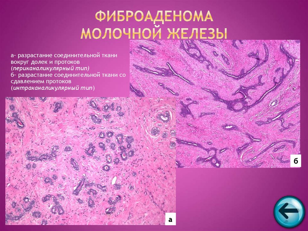 Разрастание ткани. Интраканаликулярная фиброаденома молочной железы микропрепарат. Фиброаденома молочной железы патанатомия препарат. Периканаликулярная фиброаденома гистология. Листовидная опухоль гистология.