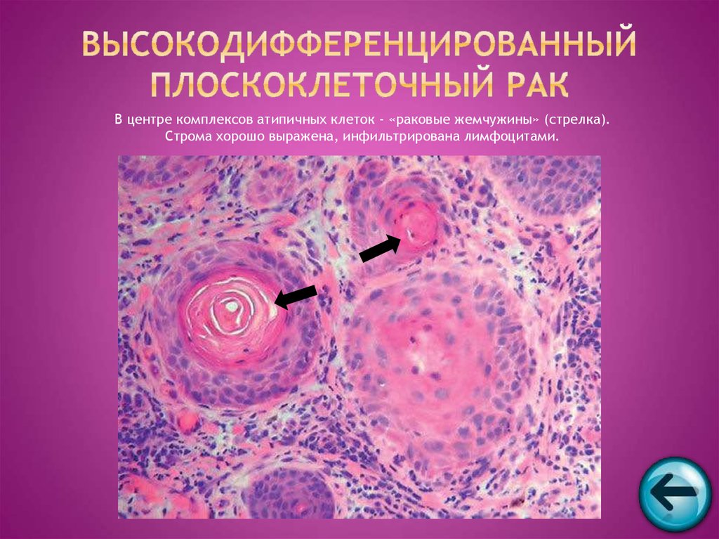 Умеренно дифференцированный плоскоклеточный рак. Инвазивной плоскоклеточной карциномы g1. Плоскоклеточная карцинома кожи гистология. Атипичные клетки патанатомия. Плоскоклеточный неороговевающий.