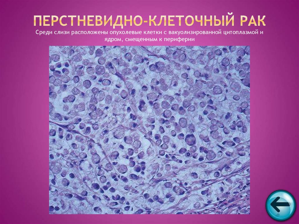 Перстневидно клеточный рак. Перстневидно клеточная аденокарцинома. Перстневидноклеточная аденокарцинома желудка g3. Перстневидная форма клеток. Карцинома с .перстневидных клеток.