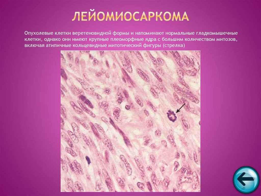 Клетки с гиперхромными ядрами. Лейомиосаркома препарат патанатомия. Лейомиосаркома матки гистология. Лейомиосаркома яичника гистология.