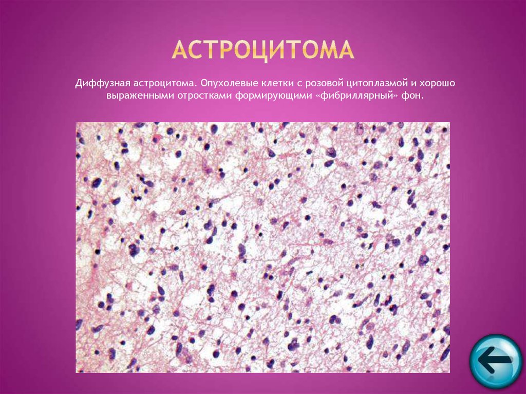 Диффузная астроцитома. Астроцитома головного мозга гистология. Астроцитома патоморфология. Астроцитома опухоль головного мозга микропрепарат. Пилоцитарная астроцитома.