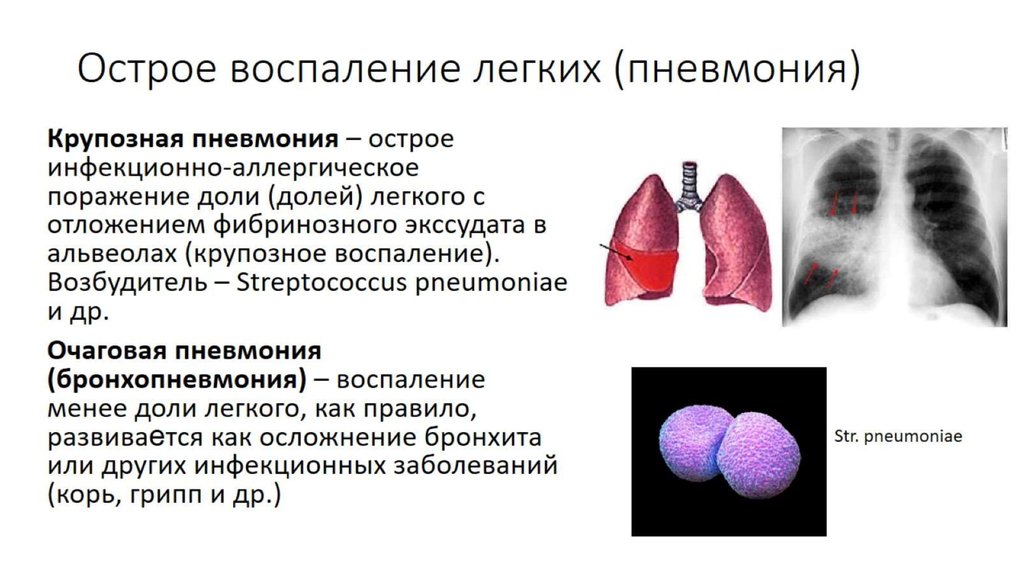 Острое воспаление легких (пневмония)