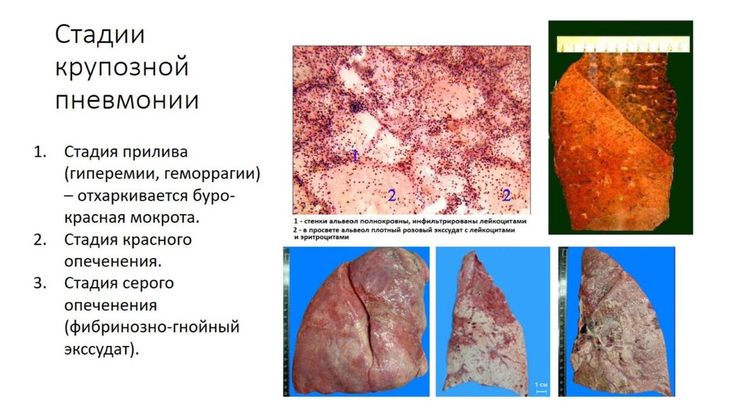 Стадии крупозной пневмонии