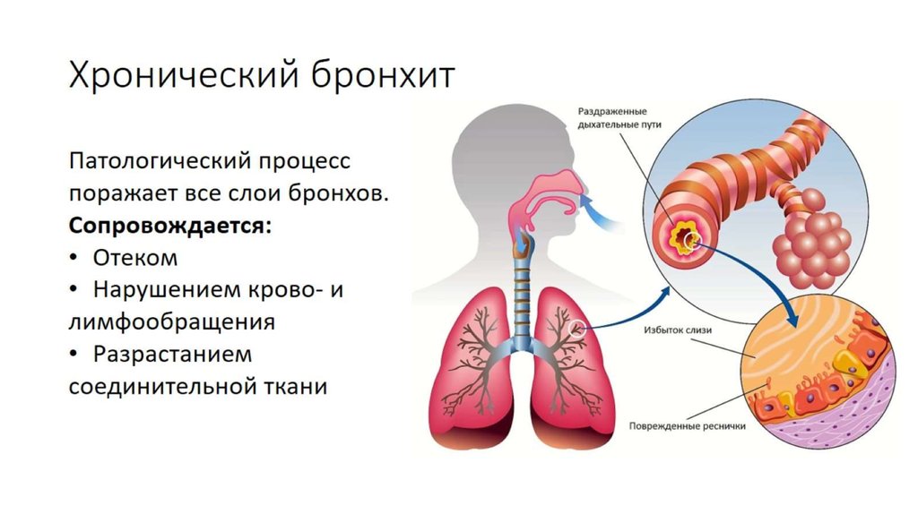 Хроническим заболеванием дыхательных. Хронический бронхит понятие. Обструктивный пылевой бронхит. Бронхит внутренние болезни.
