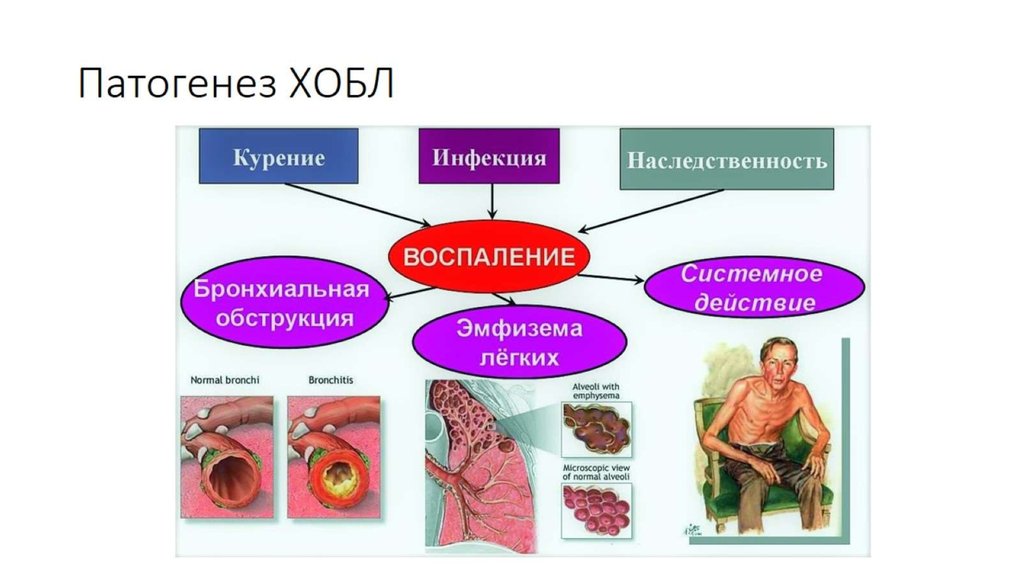 Патогенез ХОБЛ