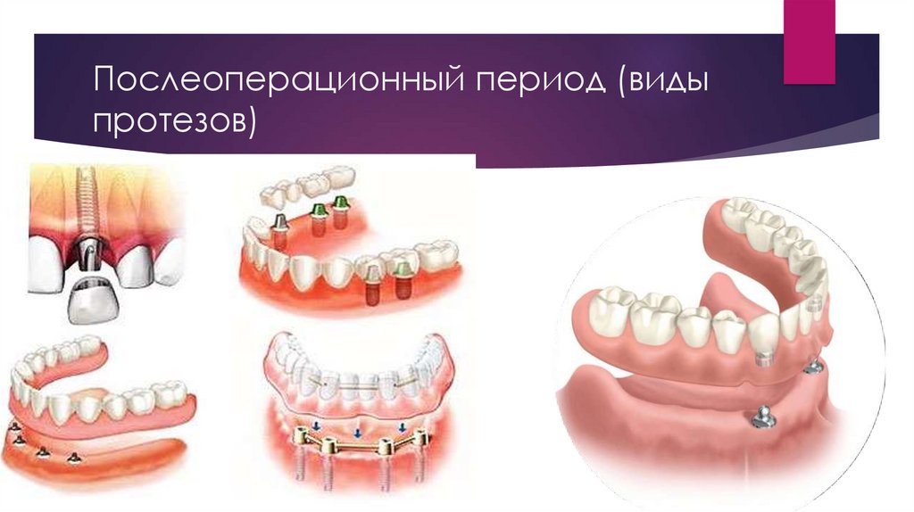 История имплантологии в стоматологии презентация