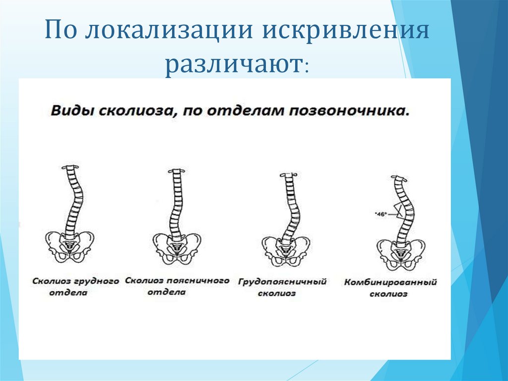 Какие искривления позвоночника. Сколиоз по локализации. Классификация сколиоза. Сколиоз по локализации искривления. Типы сколиотического искривления позвоночника.