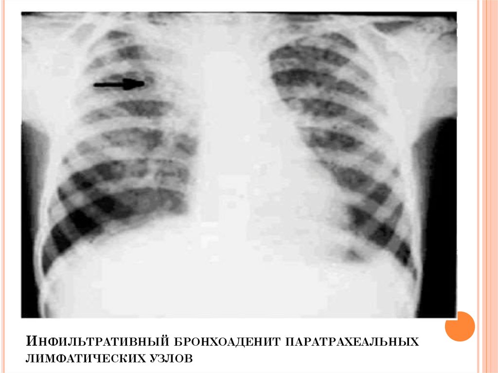 Кальцинаты в лимфоузлах. Туберкулез лимфатических узлов рентгенограмма. Туберкулез внутригрудных лимфатических узлов формы рентген. Туберкулез внутригрудных лимфоузлов рентген. Туберкулезный бронхоаденит.