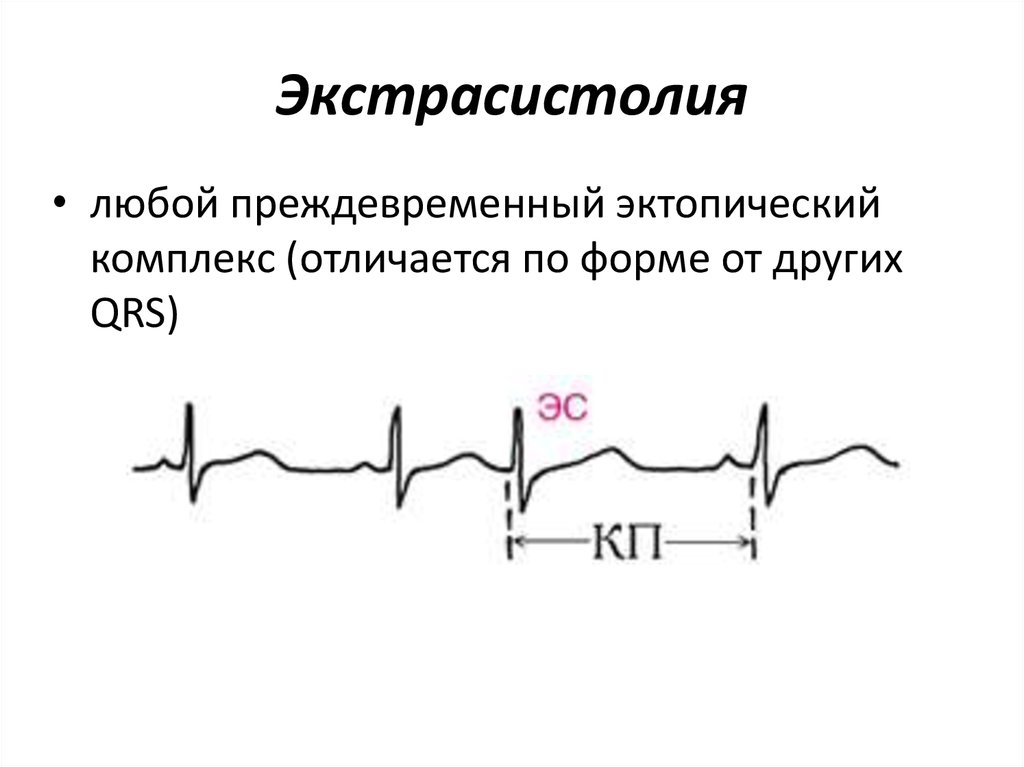 Экстрасистолы это. Аритмия и экстрасистолия на ЭКГ. Экстрасистолия ЭКГ У детей. Экстрасистолия сердца на ЭКГ. Желудочковая экстрасистолия физиология.