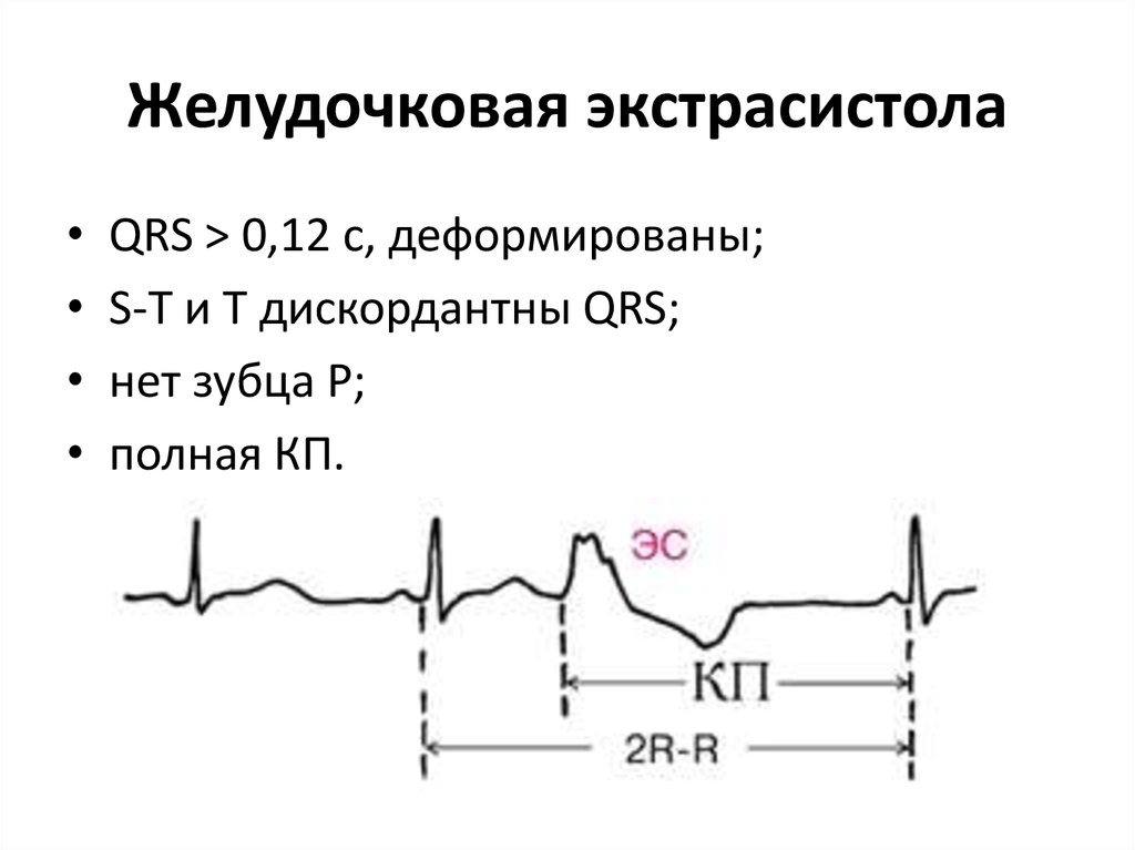 Экстрасистолы 4. ЭКГ монотопные желудочковые экстрасистолы. ЭКГ-критерий желудочковой экстрасистолии. Желудочковая экстрасистолия на ЭКГ. Желудочковые экстрасистолы на ЭКГ.
