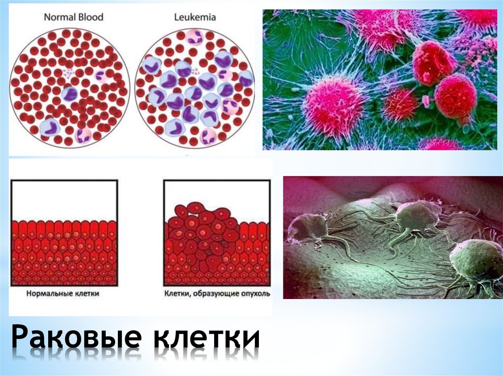 Раковые клетки