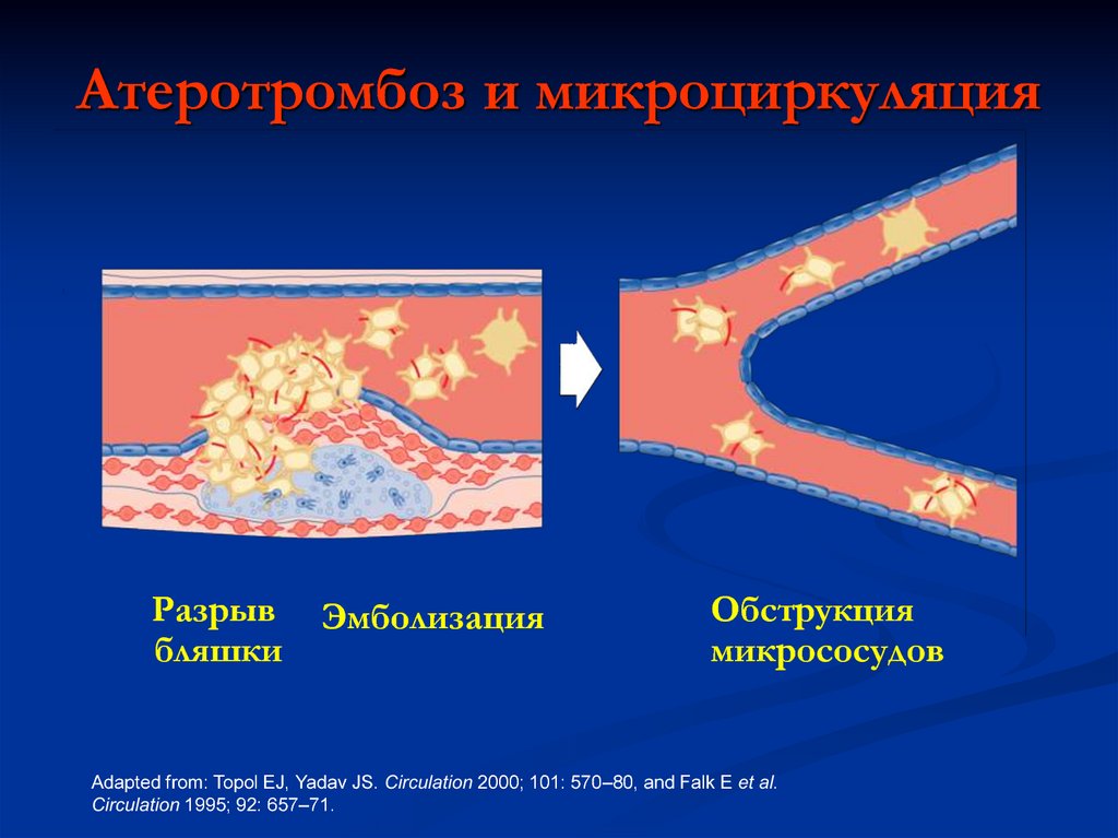 Разрыв бляшки. Атеросклероз Факультетская терапия презентация. Атеросклероз и Атеротромбоз.