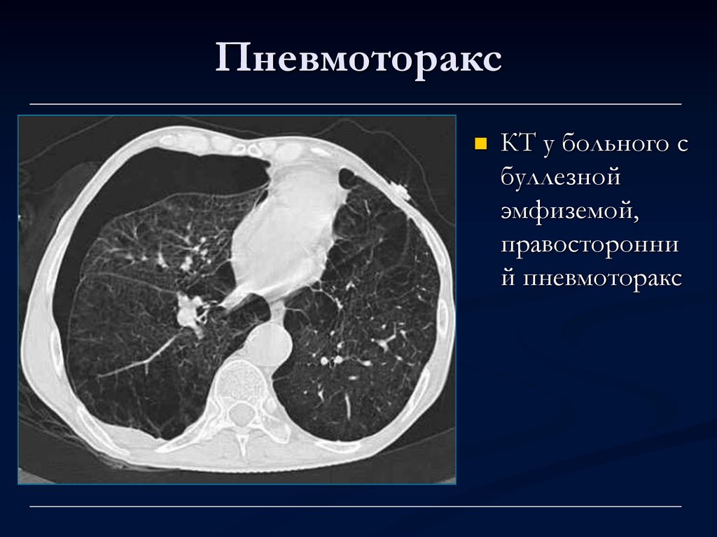 Пневмоторакс лучевая диагностика презентация