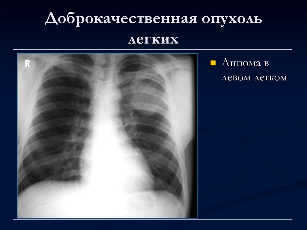 Доброкачественная опухоль рисунок