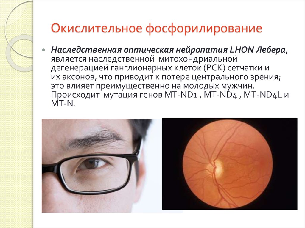 Нейропатия глаза. Наследственная оптическая нейропатия Лебера. Атрофия зрительного нерва генетика. Нейропатия зрительного нерва Лебера.