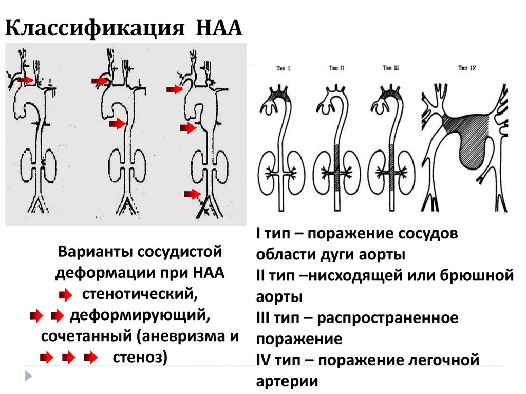 Наа. II Тип дуги аорты классификация. Васкулит легочной артерии. III Тип дуги аорты. Типы области поражения артерии.