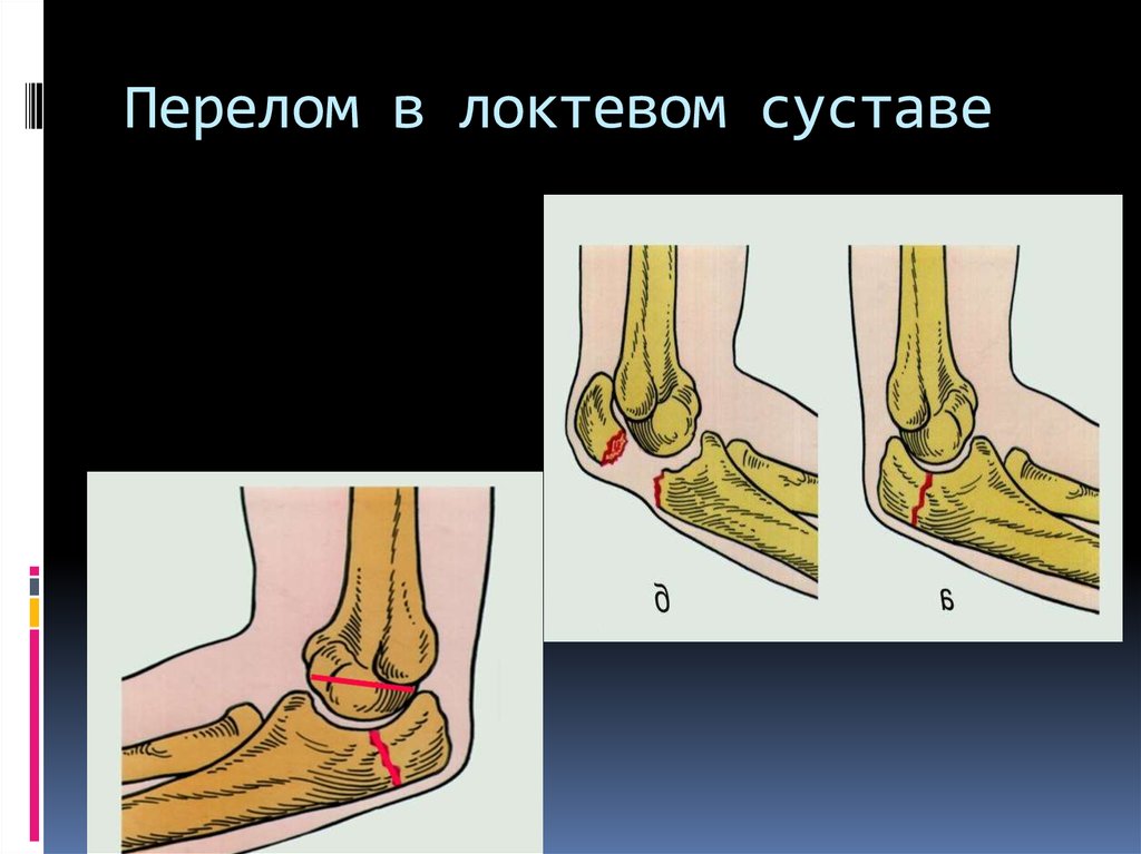 Перелом локтя