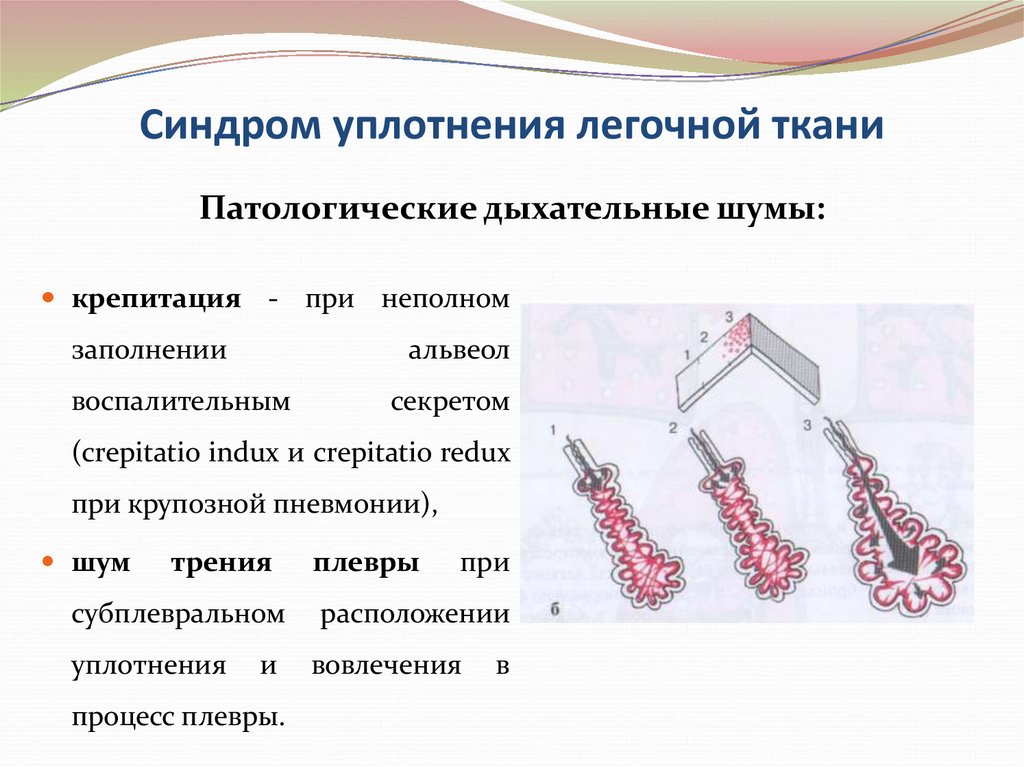 Уплотнение легочной ткани. Синдром уплотнения легочной ткани клинические проявления. Синдром долевого уплотнения легочной ткани пропедевтика. Синдром диффузного уплотнения легочной ткани. Синдром легочного уплотнения пропедевтика.