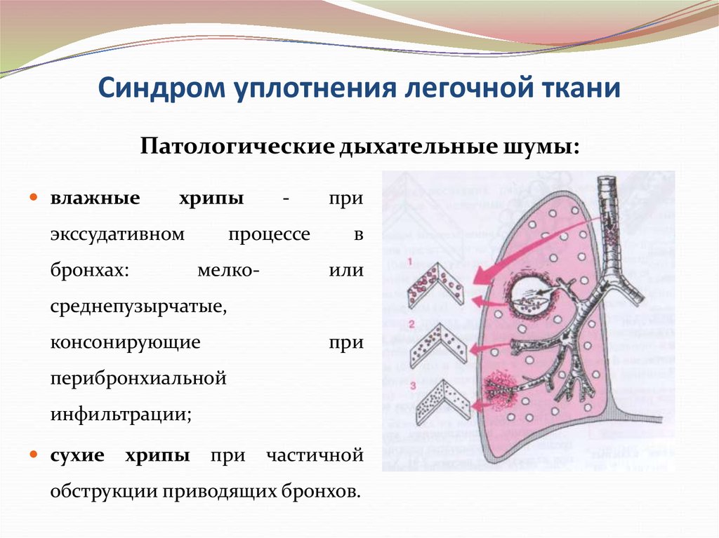 Хрипы в бронхах. Синдром воспалительного уплотнения легочной ткани. Синдром уплотнения легочной ткани клинические проявления. Синдром очагового уплотнения легочной ткани симптомы. Синдром уплотнения легочной ткани пропедевтика.