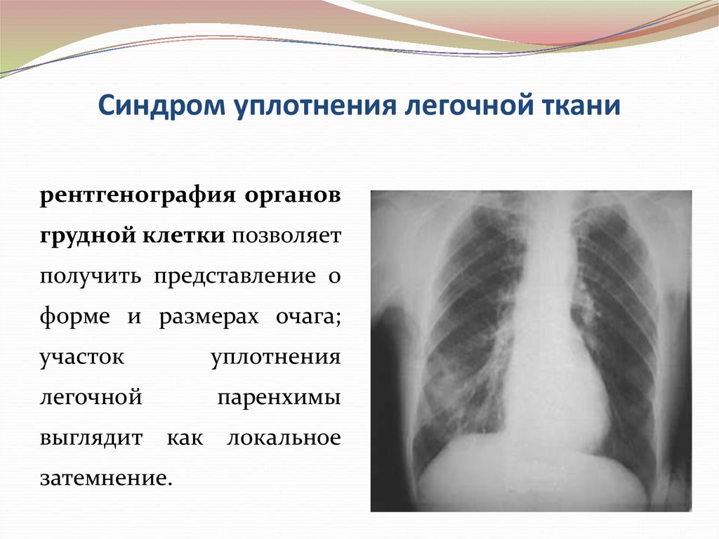 Уплотнение нижней доли легкого. Синдром легочного уплотнения рентген. Синдром уплотнения легочной ткани рентген. Синдром уплотнения легкого рентген. Синдром крупноочагового уплотнения легочной ткани.