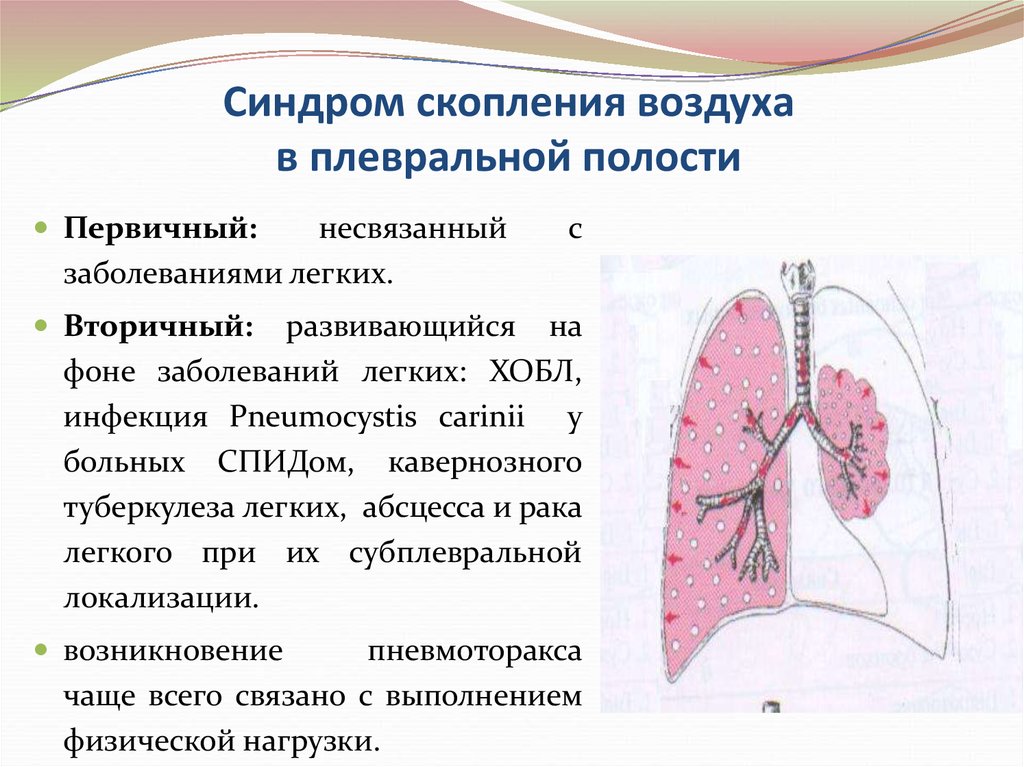 Воздух в легких. Синдром скопления воздуха в плевральной полости (пневмоторакс). Синдром накопления воздуха в плевральной полости. Синдром плевральных шварт. Наличие воздуха в плевральной полости.