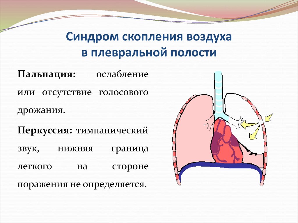 Дыхание в плевральной полости. Скопление воздуха в плевральной полости. Воздух в плевральной полости. Синдром воздуха в плевральной полости. Синдром накопления воздуха в плевральной полости.