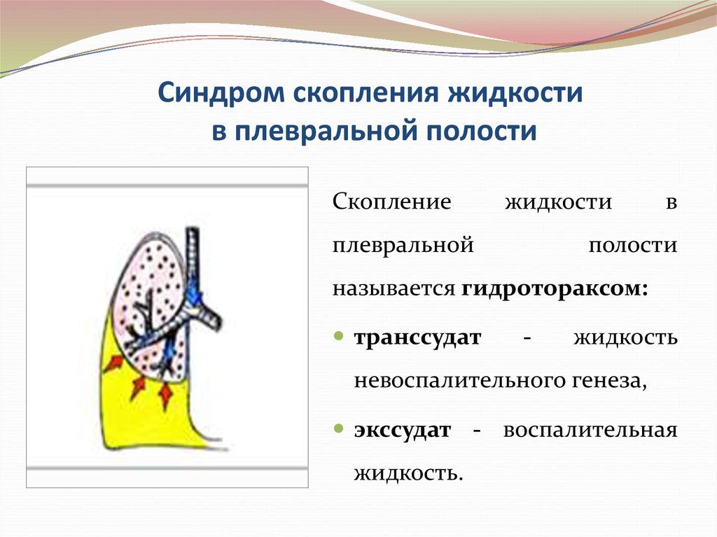 Скопление жидкости в полостях. Жидкость в плевральной полости. Скопления жидкости в плевральной полост. Наличие невоспалительной жидкости в плевральной полости. Синдром скопления жидкости в плевральной полости.