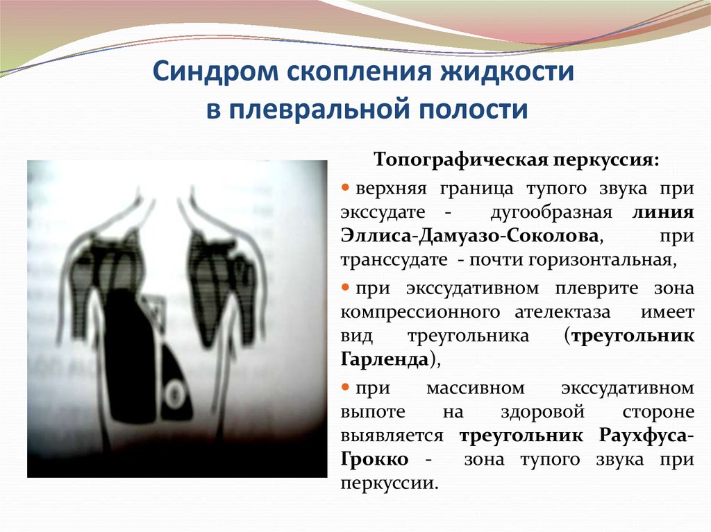 Скопление в плевральной полости. Скопления жидкости в плевральной полост. Синдром скопления жидкости в плевральной полости. При синдроме скопления жидкости в плевральной полости. Для синдрома скопления жидкости в плевральной полости характерно:.