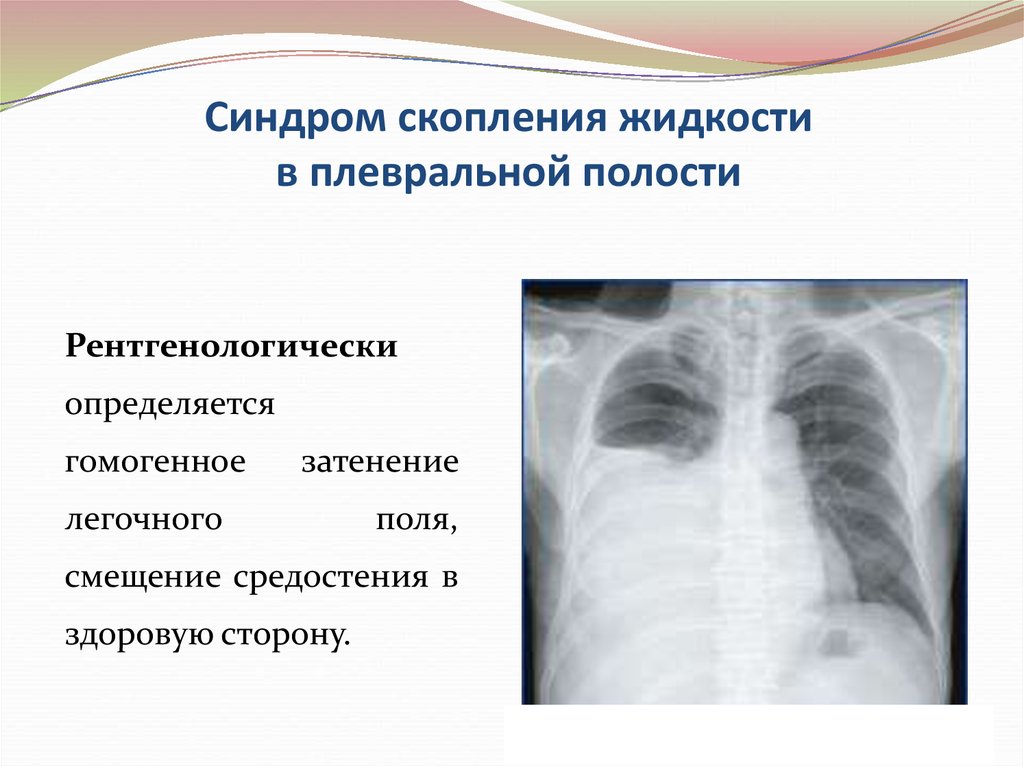 Объем гидроторакса. Скопление жидкости в плевральной полости рентген. Синдром скопления воздуха в плевральной полости рентген. Синдром скопления жидкости в плевральной полости. Жидкость в плевральной полости рентген.