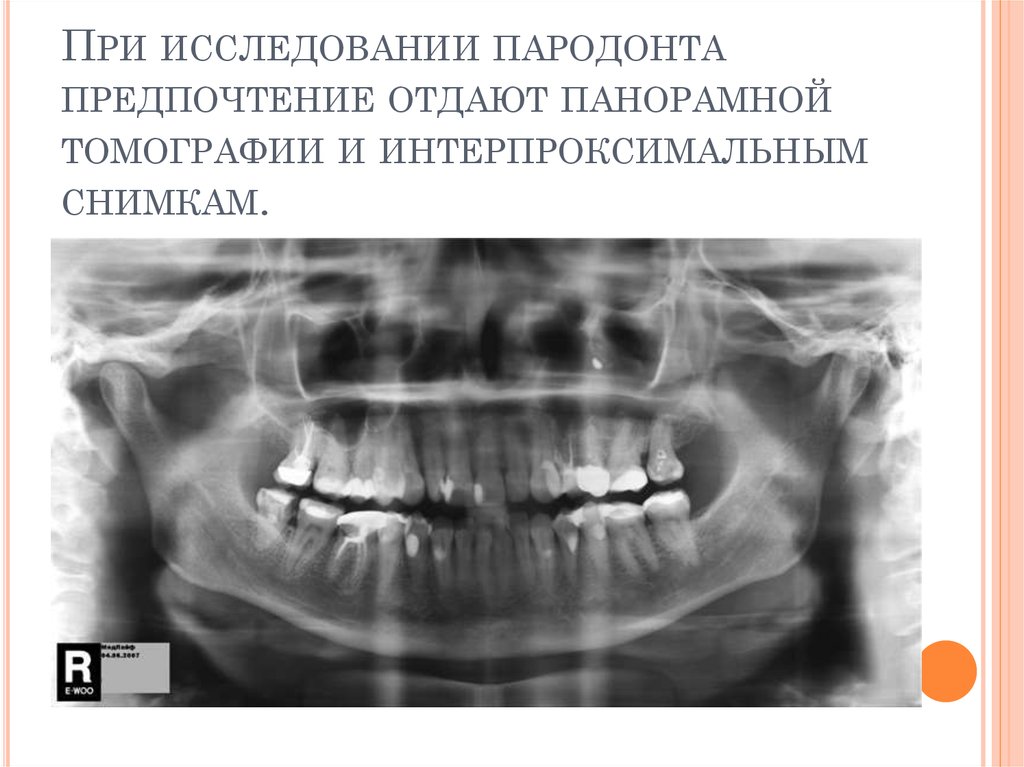 Пародонтит рентгенологическая картина