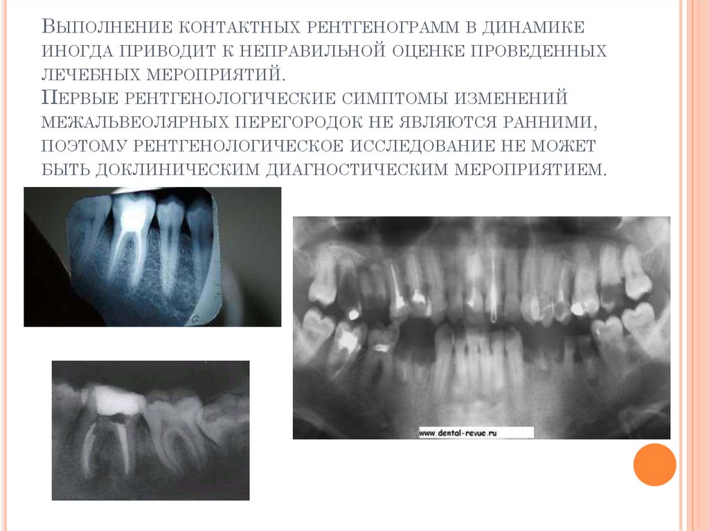 Рентгенологическая картина пародонтоз