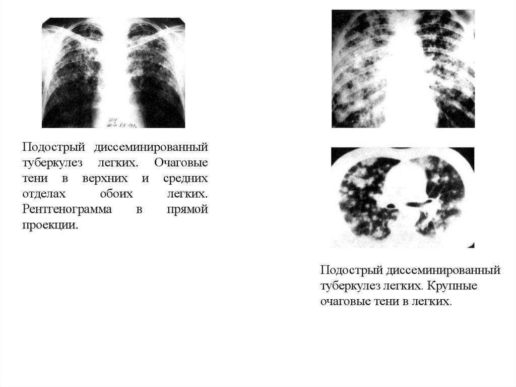 Острый диссеминированный туберкулез. Острый диссеминированный туберкулез рентген. Диссеминированный туберкулез на кт. Хронический диссеминированный туберкулез рентген. Хронический диссеминированный туберкулез кт.
