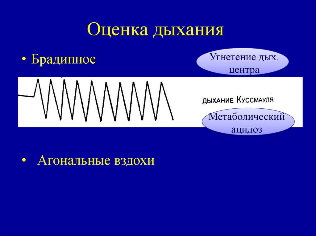 Дыхание куссмауля рисунок