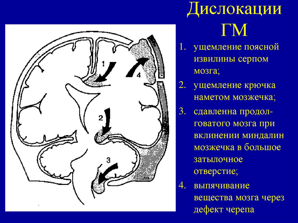 Дислокация мозгах