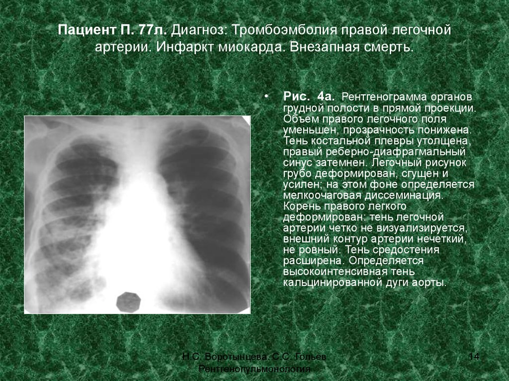 Легочный рисунок сгущен. Рентгенограмма органов грудной полости в прямой проекции. Инфаркт легочной артерии что такое. Инфаркт миокарда и тромбоэмболия легочной артерии. Тэла при инфаркте миокарда.