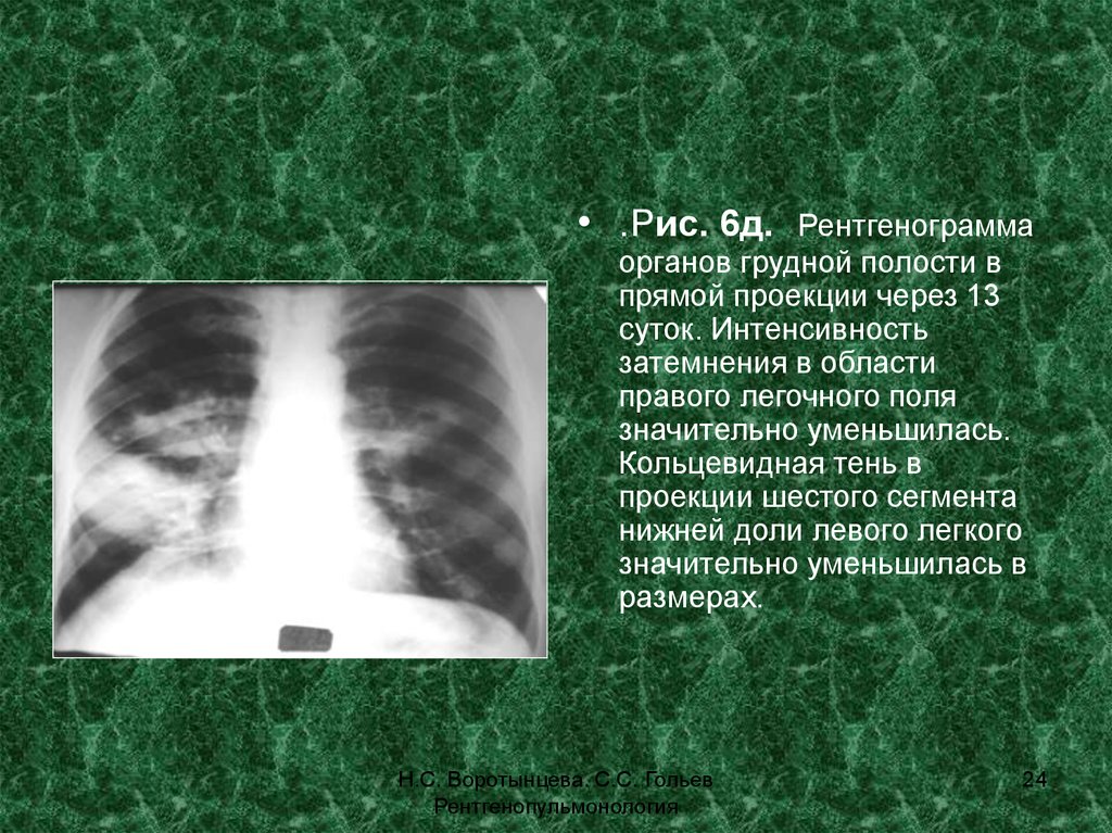 Прямая проекция рентгенограмма. Рентгенологический синдром кольцевидной тени. Рентгенограмма органов грудной полости. Рентгенограмма органов грудной полости в прямой проекции. Синдром кольцевидной тени на рентгенограмме легких.