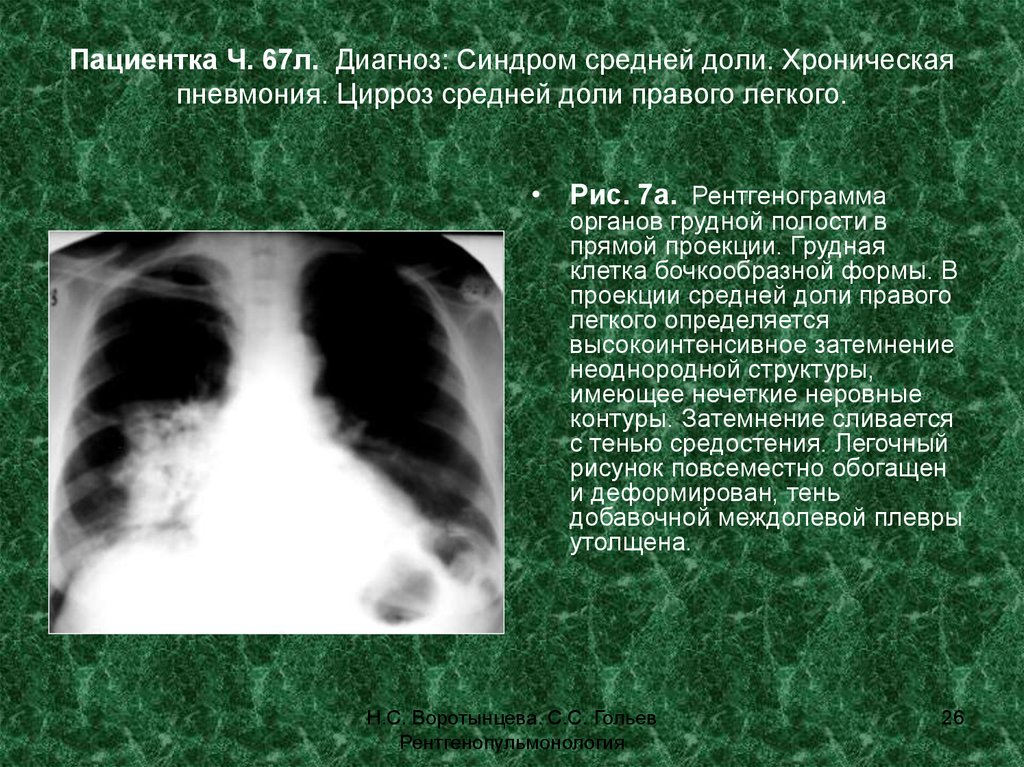 Дол диагноз. Цирротический туберкулез рентген. Пневмония рентген боковая проекция. Синдром средней доли рентгенограмма. Синдром средней доли правого легкого рентгенограмма.