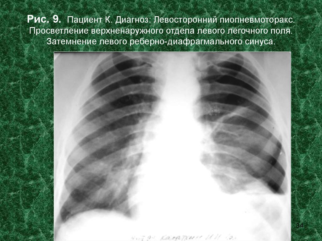 Просветление в легких. Пиопневмоторакс рентгенограмма. Реберно-диафрагмальный синус рентген.