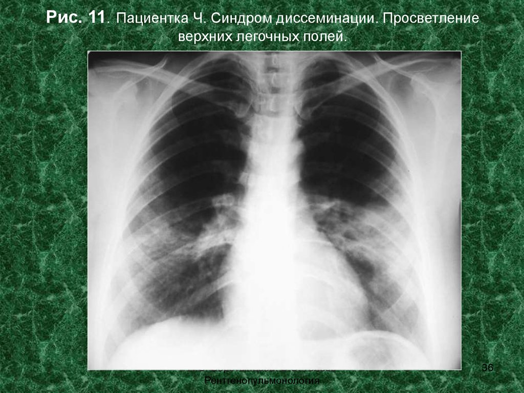 Поле легкого. Бронхогенная диссеминация рентген. Диссеминированный синдром рентген. Синдром диссеминации на рентгенограмме. Ограниченная диссеминация легких рентген.