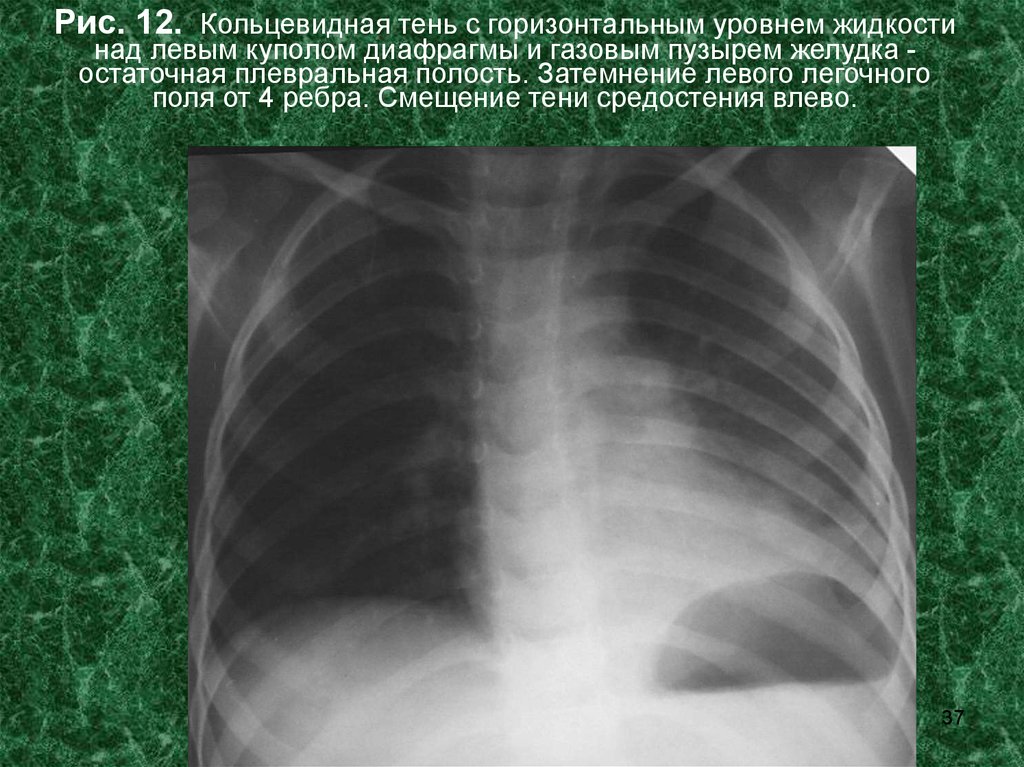 Горизонтальные уровни жидкости. Газовый пузырь желудка на рентгене. Газовый пузырь желудка на рентгене легких. Газовый пузырь желудка на рентгенограмме. Газовый пузырь на рентгенограмме.