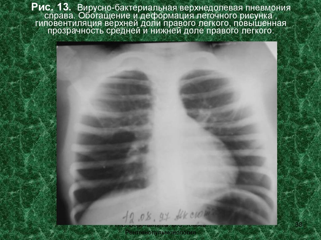 Пневмония верхней доли легкого. Гиповентиляция легкого на рентгене. Рентген верхнедолевой пневмонии. Гиповентиляция на рентгенограмме. Гиповентиляция верхней доли рентген.