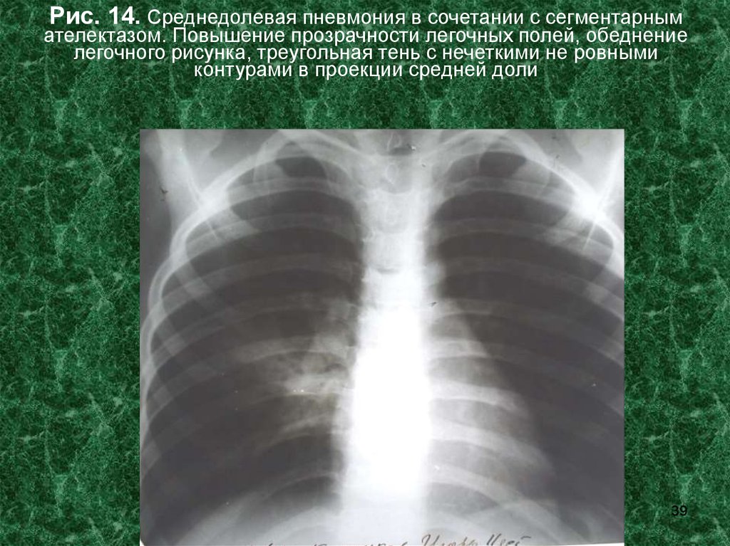 Сегментарная пневмония. Рентген правосторонней среднедолевой пневмонии. Правосторонняя среднедолевая пневмония рентген. Среднедолевая пневмония рентген. Среднедолевая пневмония справа рентген.