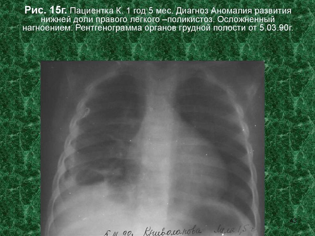 Диагноз аномалия. Поликистоз легких рентген. Пороки развития грудной клетки и органов грудной полости. Лоботомия нижней доли легких с Лева. Аномалии развития 3 сегмента правого легкого.